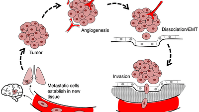 Malignant Neoplasm Adalah Kanker: Pengertian Lengkap